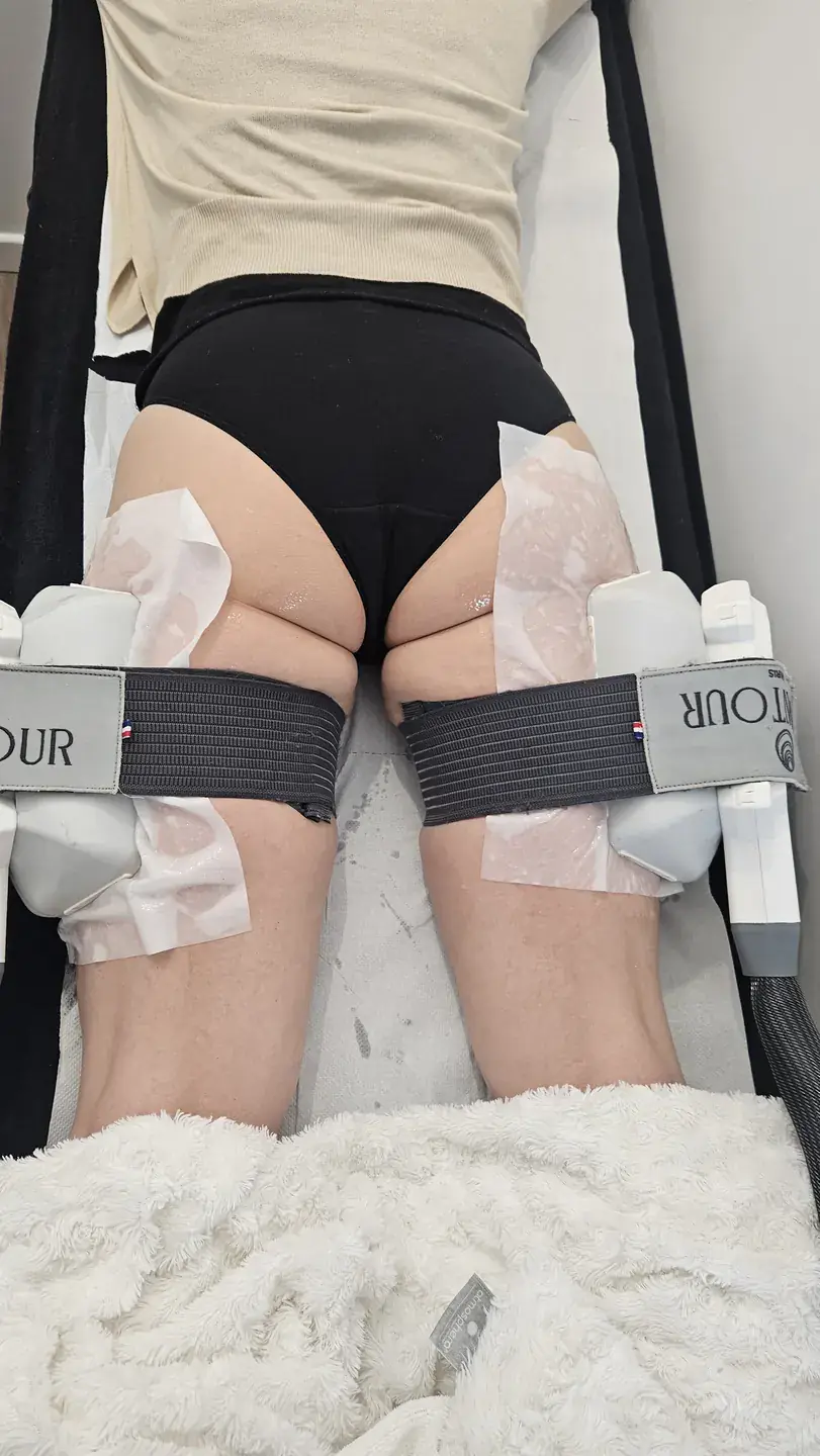 Séance de cryolipolyse sur l'arrière des cuisses, deux applicateurs Contour Paris en place, au centre Dermage Clinic