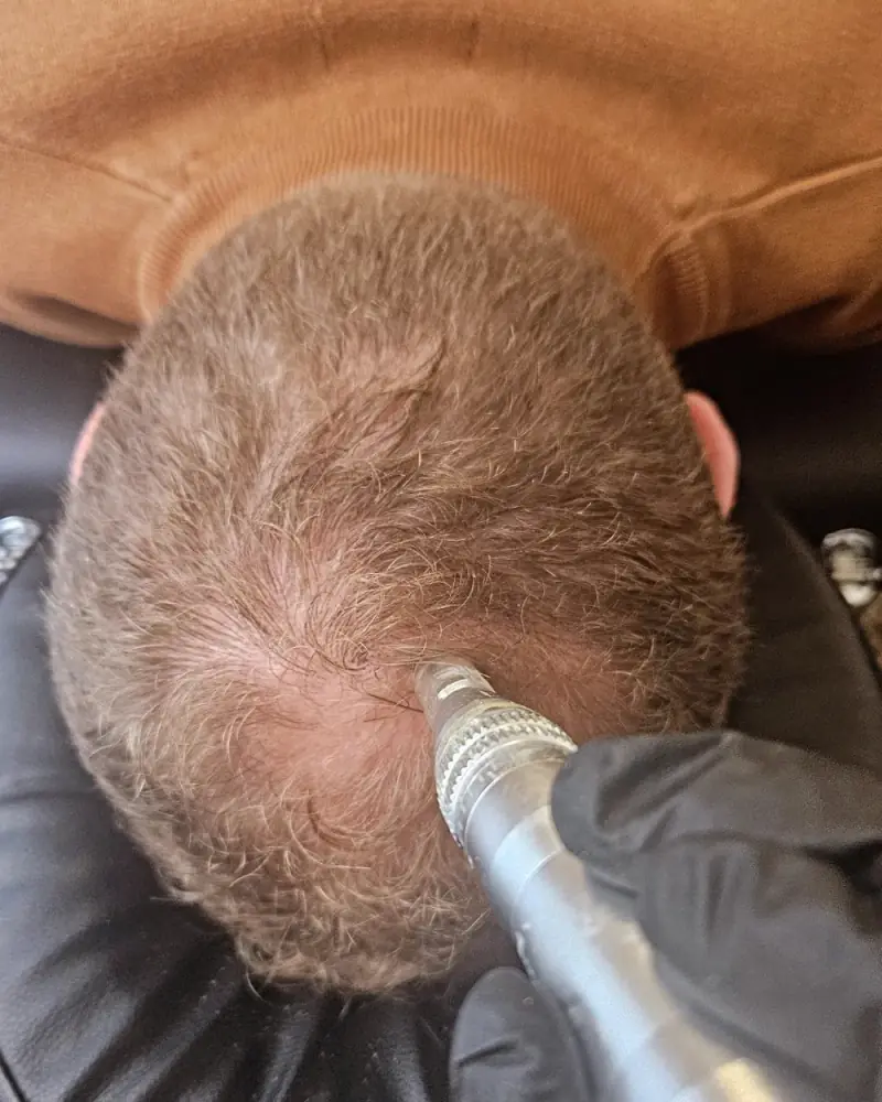 Micro-stimulation du cuir chevelu le long de la raie, au centre Dermage Clinic à La Rochelle