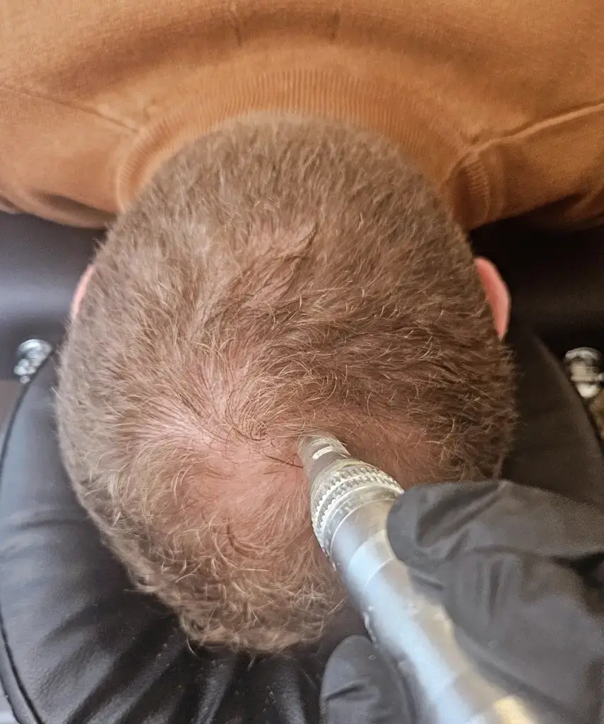 Micro-stimulation du cuir chevelu d'un homme, vue de dessus
