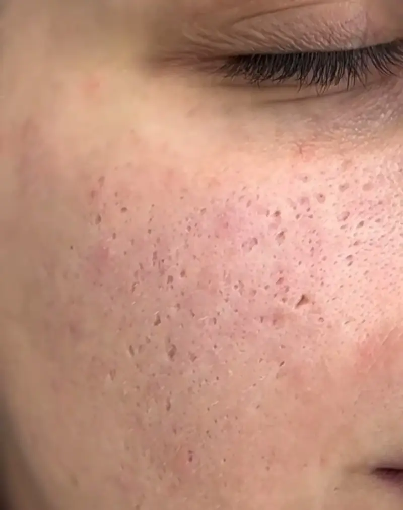 Peau du visage en gros plan, pores visibles et marques d'imperfections sur la joue