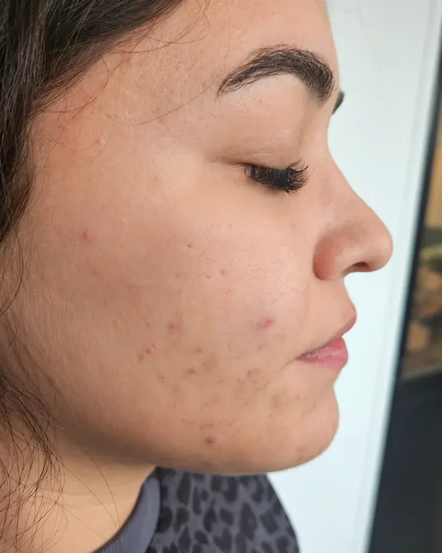Après : la même joue au terme d'une cure de peelings doux, imperfections et marques atténuées