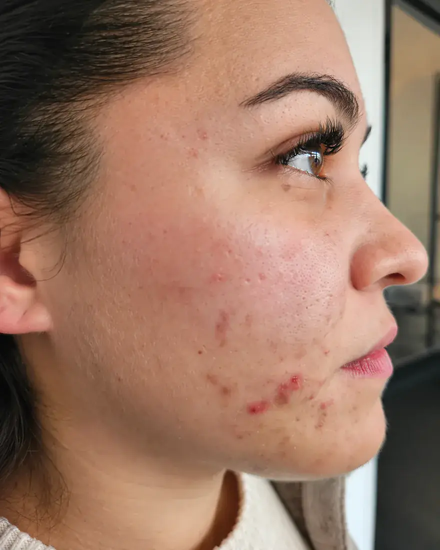 Avant : joue d'une cliente présentant des imperfections et des marques, au centre Dermage Clinic à La Rochelle