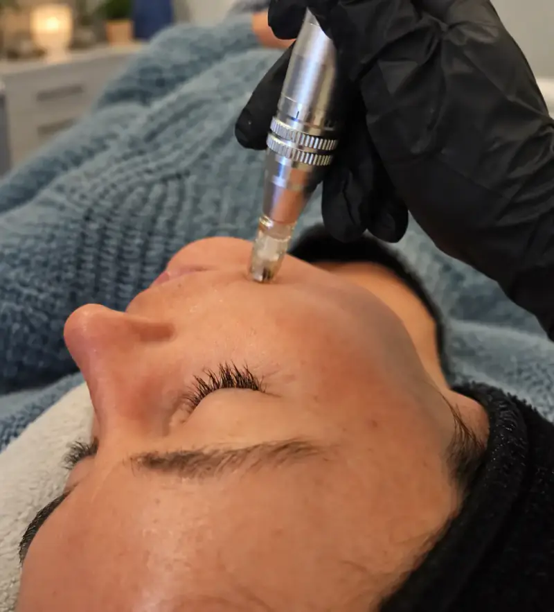 Séance de micro-stimulation cutanée sur le front d'une cliente au centre Dermage Clinic à La Rochelle